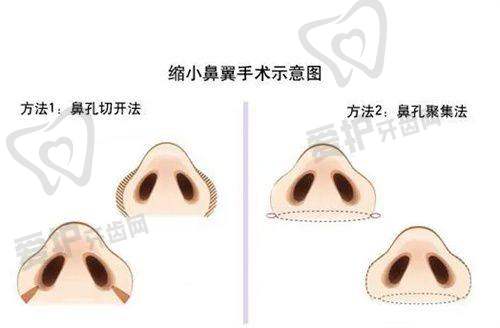 周云超医生技术特色