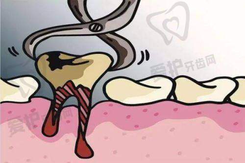 汕头奥诗卡口腔做儿童乳牙(双尖牙)根管治疗的优势