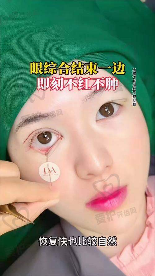 杭州瑞丽医疗美容医院李文鹏医生做眼部综合5项的具体优势