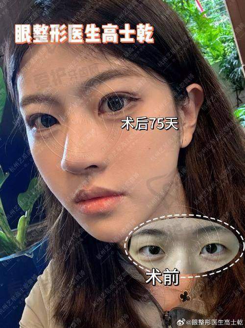 杭州瑞丽医疗美容医院李文鹏医生眼部综合5项4532元起，解决眼部问题还你明亮有神双眸