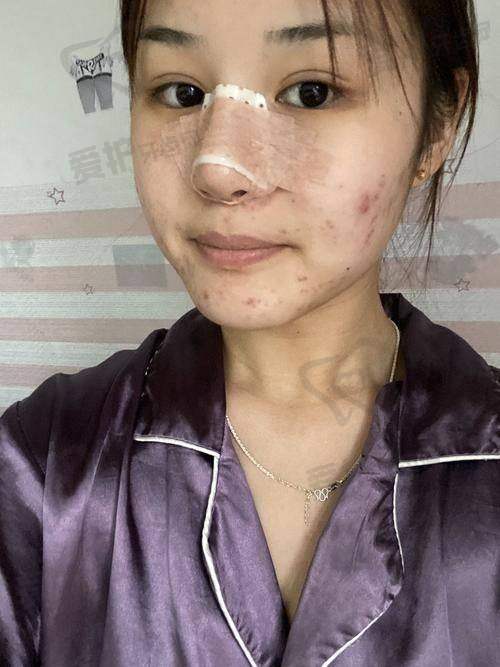 贵州利美康外科医院肋软骨鼻综合29204元起，技术先进材料安全打造自然美鼻