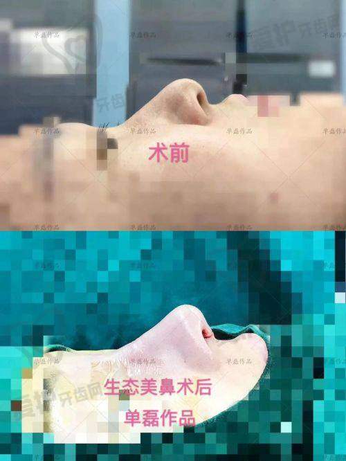 患者对贵州利美康外科医院肋软骨鼻综合的真实口碑评价