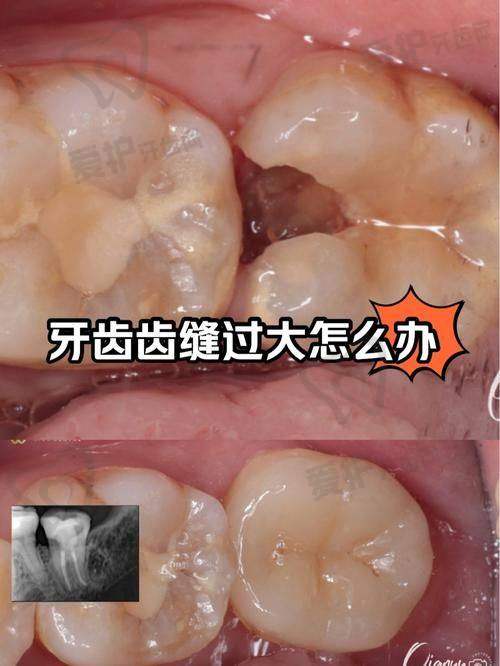 医院做后磨牙根管治疗的具体优势