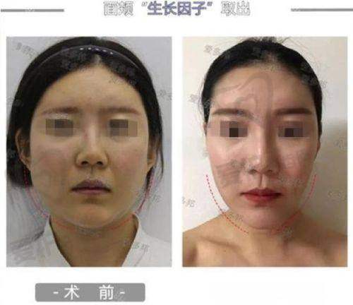 超脂塑体雕术与传统抽脂的麻醉方式有何不同？