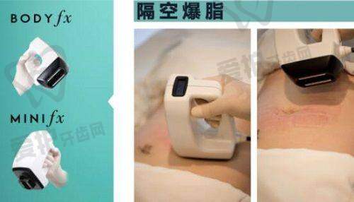 超脂塑体雕术与传统抽脂的价格有区别吗？