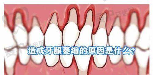 年龄增长与自然变化会让牙缝变宽吗？