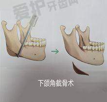 如何根据自身情况选择填充材料？