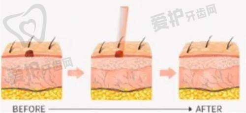 什么情况下优先选择体雕？
