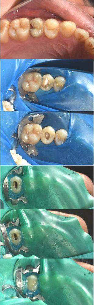 汕头奥诗卡口腔医院做后磨牙根管治疗 + 3M 补牙项目的优势