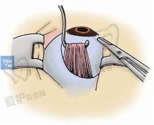 巩膜镜潜在风险:不可忽视的“隐忧”
