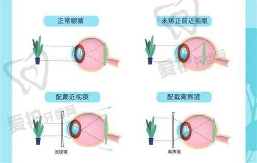 全飞秒近视手术的过程是怎样的?