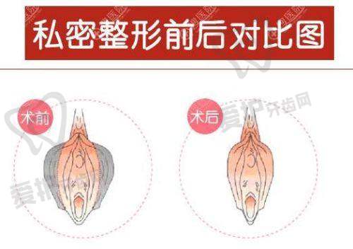 侯智慧医生在女性私密整形领域的优势