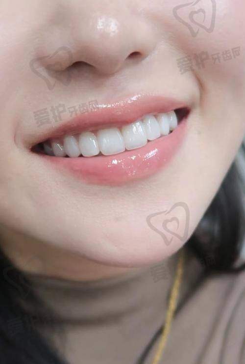 长沙中诺口腔医院牙齿贴面美白仅1300元起，焕白美齿开启自信笑容魔法！