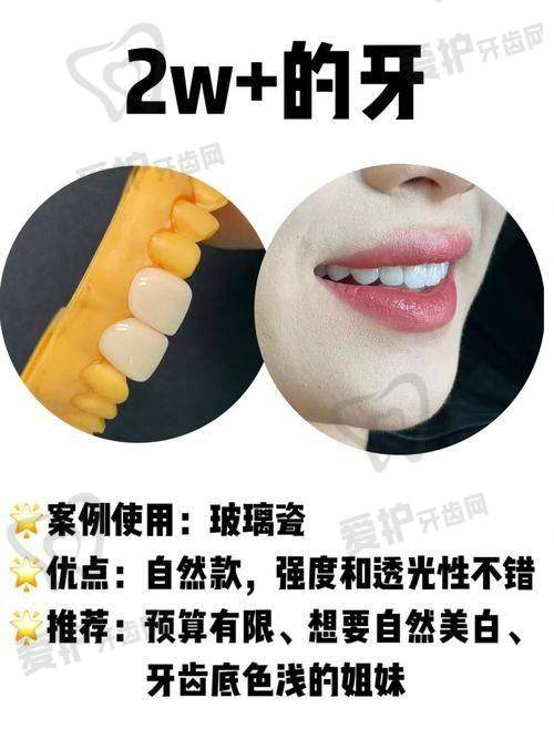 长沙中诺口腔医院牙齿贴面美白的优势