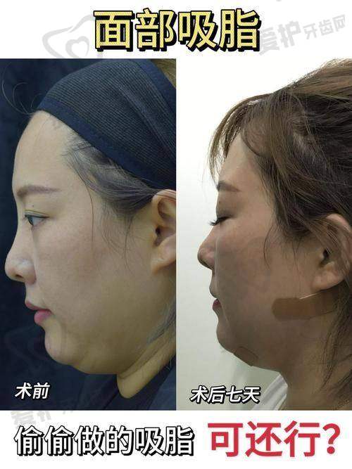 长沙梵童医疗美容吸脂是否存在不足？