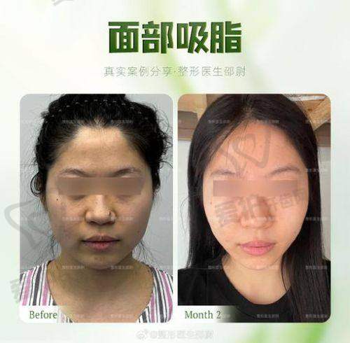 长沙梵童医疗美容吸脂价格和口碑情况如何？