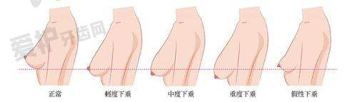 打艾维岚童颜针有哪些注意事项?