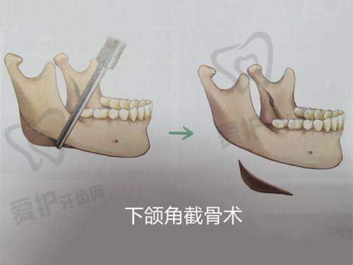 艾维岚童颜针是什么?