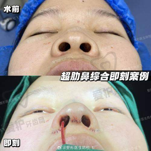 出彩国内鼻：46000元起能带来什么成效？