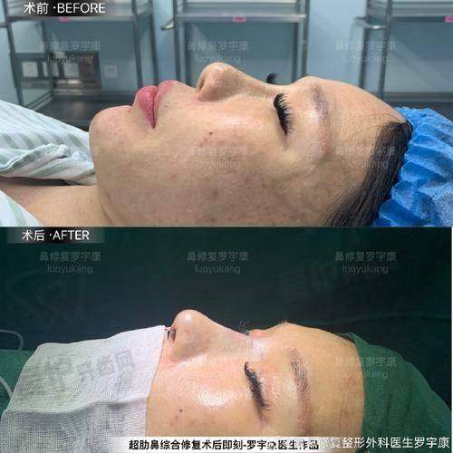 出彩国内鼻项目：手术过程是怎样的？