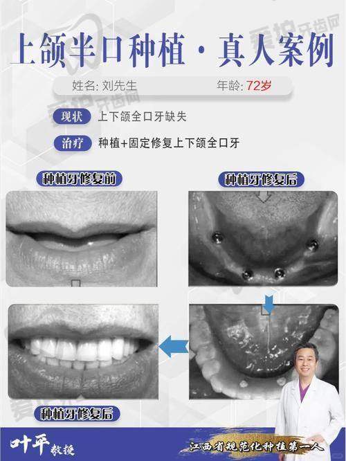 选择汕头奥诗卡口腔沈承骏医生全口牙种植需要注意什么？