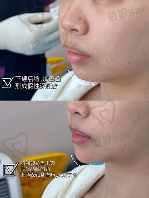 乔雅登极致：深层皱纹和凹陷填充的有力武器