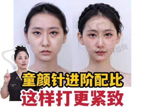 乔雅登缇颜：填充动态纹的优质之选