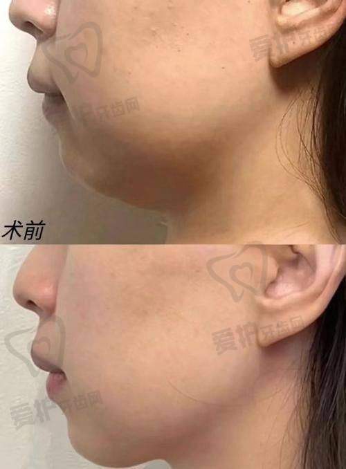 北京清木马梅生面部吸脂仅16800元起，塑造精致小脸，开启颜值焕变之旅！