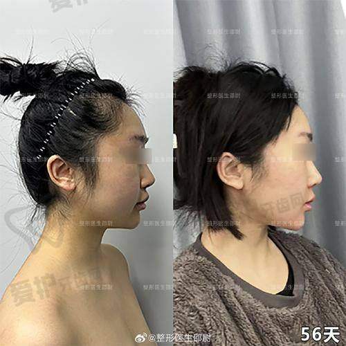 北京清木马梅生面部吸脂价格分阶情况