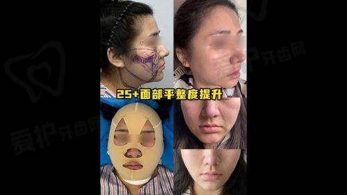 北京清木马梅生面部吸脂的实例分享