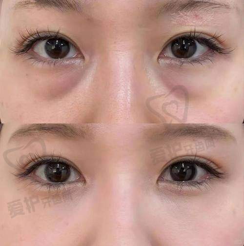 广州美诗沁不开刀去眼袋的术后护理重要吗?