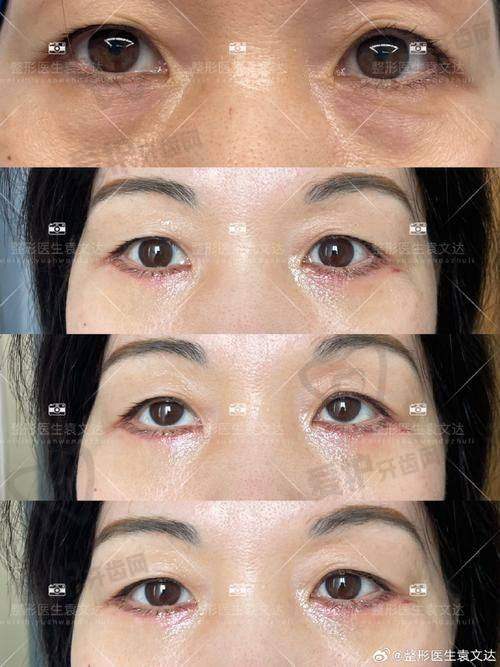 广州美诗沁不开刀去眼袋价格究竟如何?