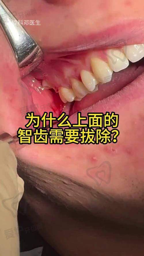 为什么有些智齿需要拔掉？