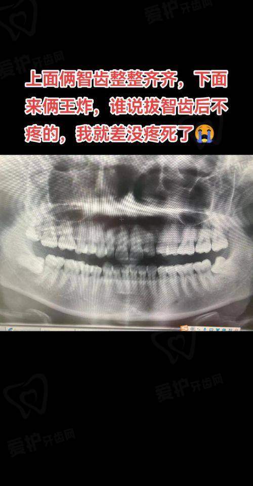 不疼的智齿就一定不用拔吗？