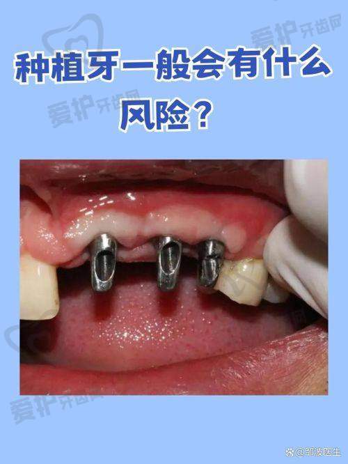 种植牙的寿命一般是多少年？