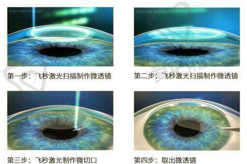 中山爱尔眼科医院半飞秒近视手术价格分阶情况