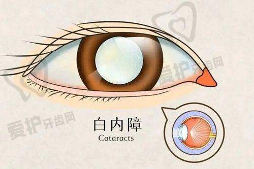 患者在潍坊明润眼科医院诊疗白内障的真实实例是怎样的?