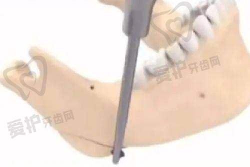 植发技术及价格