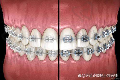 进口金属托槽矫正的过程是怎样的？