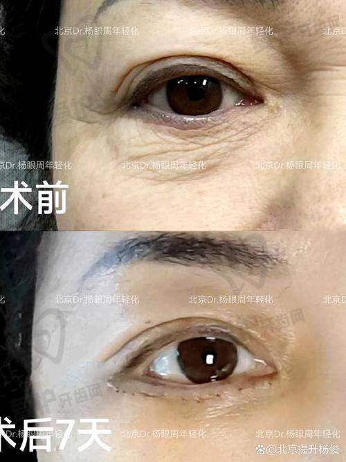韩国在双眼皮改单眼皮领域的优势