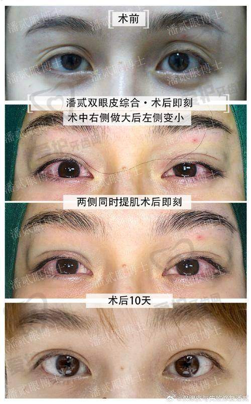 国内双眼皮改单眼皮的现状