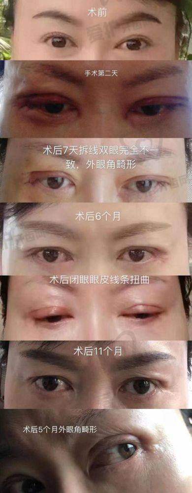 双眼皮改单眼皮无疤成效的意义