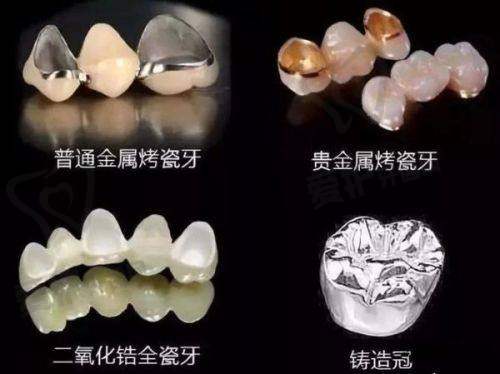 西安中诺口腔的爱尔创全瓷牙冠值得选择吗？