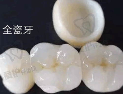 爱尔创全瓷牙冠1380元起的价格是怎么回事？