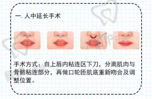 手术具体流程是怎样的？
