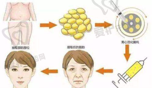 注射塑妍萃固定轮廓后需要注意什么?