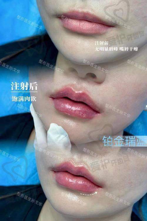 热敷对注射导致的脸部馒化变薄有帮助吗？