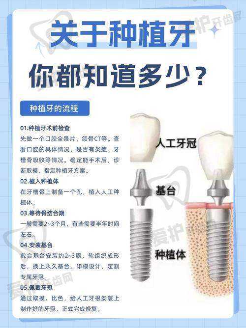 西安中诺口腔韩国美格真种植牙的价格是如何构成的？