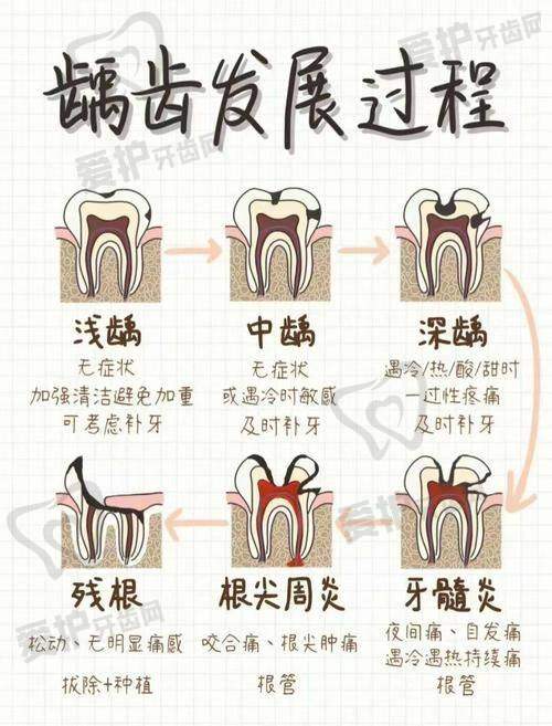 树脂补牙是怎么修复龋齿的呢？