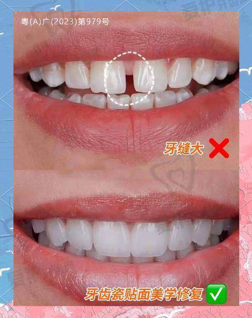 安装爱尔创全瓷牙冠后需要注意什么？